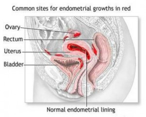 Causes, Symptoms and treatment for Endometriosis